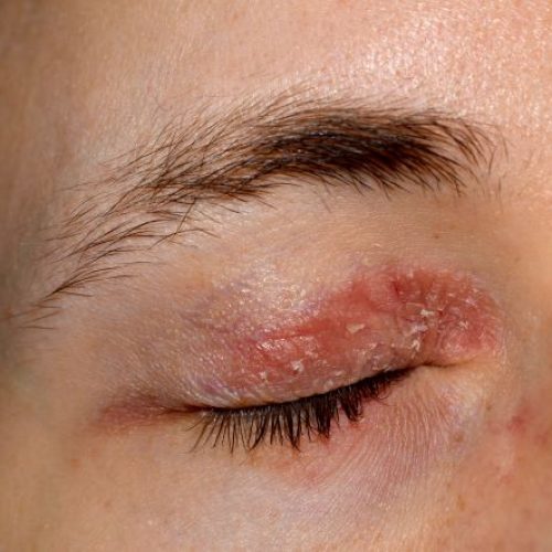 Ausgeprägtes Lidekzem am oberen Augenlid