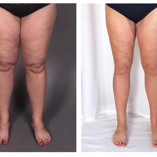 Lipödem an Beinen