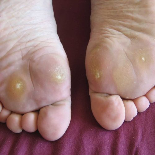 schmerzhafte Dornwarzen auf Fußunterseite