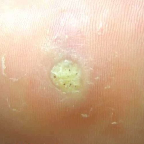 Dornwarzen in Nahaufnahme