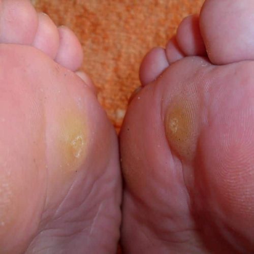 Dornwarzen, Fußunterseite