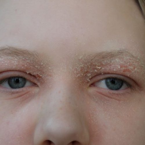 beidseitiges Lidekzem  © Arm Mari