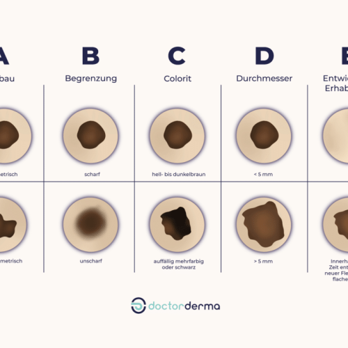 Die ABCDE-Regel für Muttermale