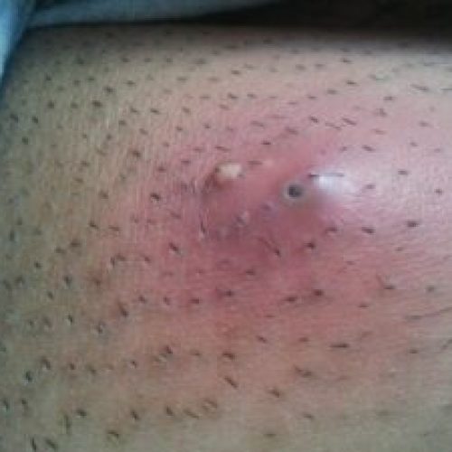 Abszess-Furunkel-300x225