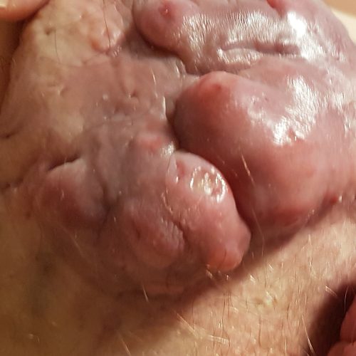 Schwere Narbenbildung bei Akne inversa