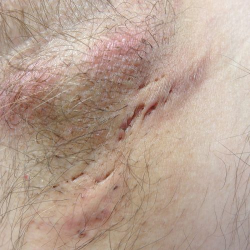 Acne inversa mit Abszess im Stadium II.