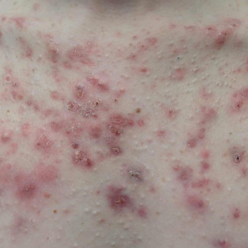 Weit verbreitete Papeln und Pusteln auf Männer Brust.