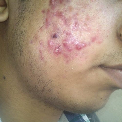 Akne Papulopustulosa im Gesicht eines jungen Mannes © User:Naveenhooda23, CC BY-SA 3.0 , via Wikimedia Commons