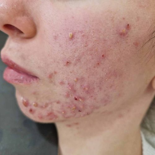 Ausgeprägte Akne Papulopustulosa im Gesicht © Sedef94, CC BY-SA 4.0 , via Wikimedia Commons