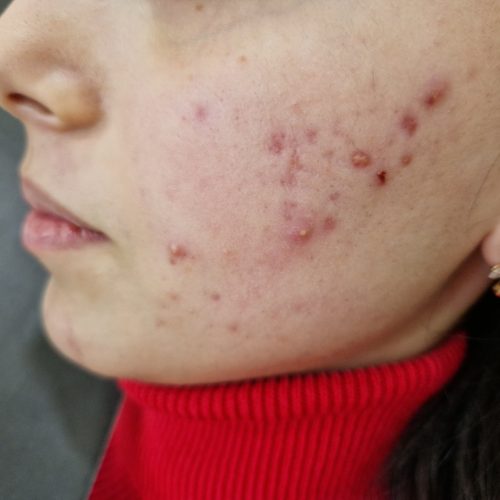 Gering ausgeprägte Pappeln und Pusteln im Gesicht einer Frau