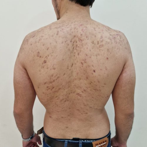 Narben auf gesamten Rücken nach Akne Erkrankung