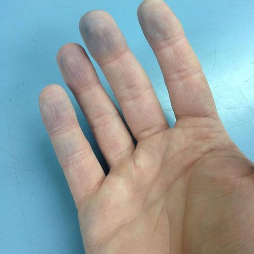 Akrozyanose Fingerspitzen