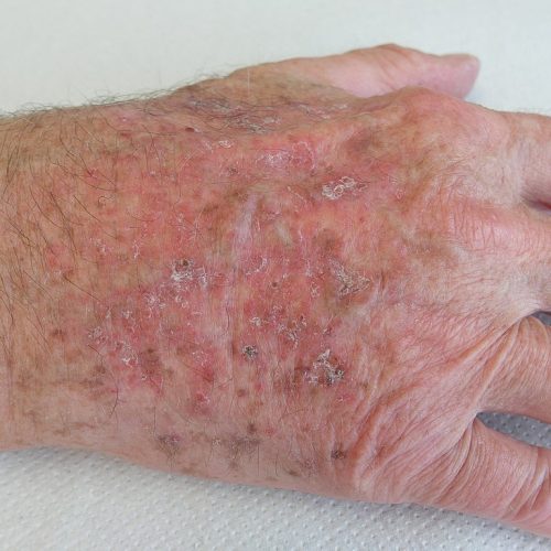 Aktinische Keratosen am Handrücken