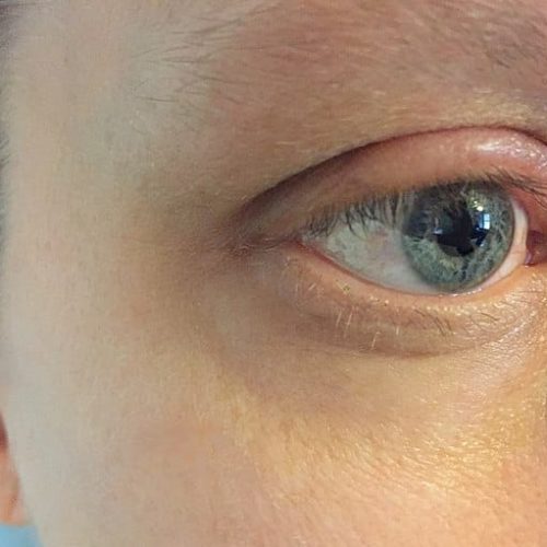 Allergie, geschwollenes Auge