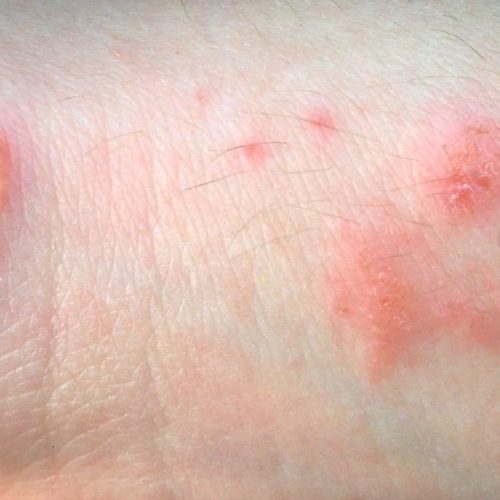 Allergisches Kontaktekzem