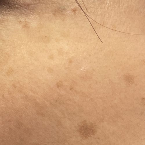 Sonnenflecken im Gesicht