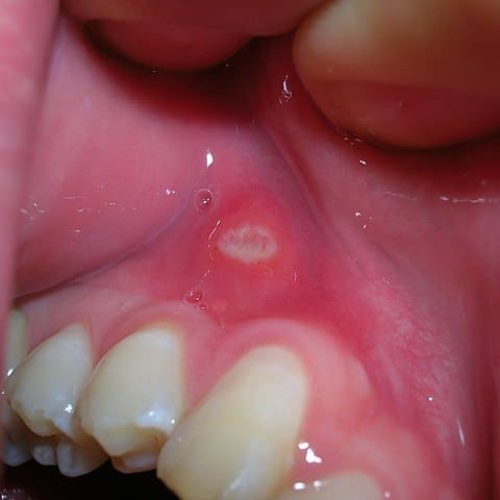 Aphthe Zahnfleisch