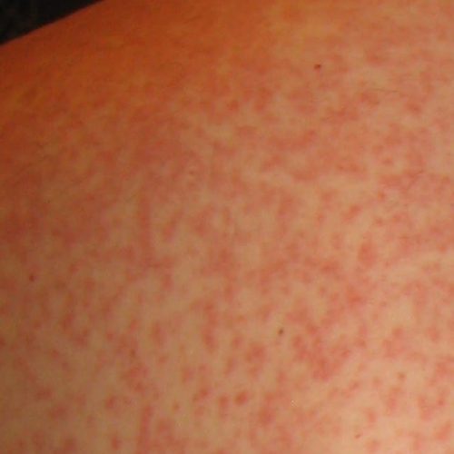 Arzneimittelexanthem