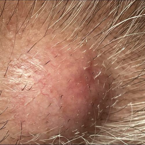 Atherom an der Kopfhaut