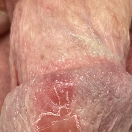 Entzündung der Eichel