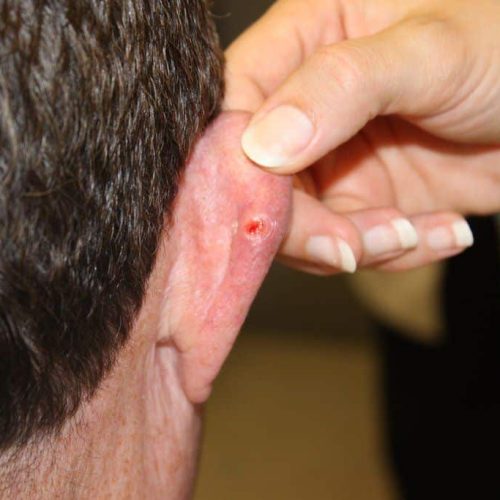 Basalzellkarzinom am Ohr