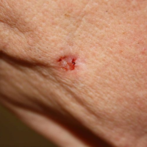 Typisches Erscheinungsbild mit eingesunkenem Zentrum eines Basalzellkarzinoms an der Wange