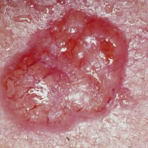 Basalzellkarzinom in Nahaufnahme