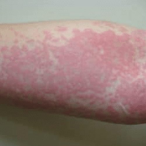 Quaddeln an der Arminnenseite einer Nesselsucht © James Heilman, MD (CC BY-SA 3.0)