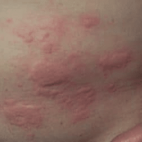 Nesselsucht am Oberkörper © Enochlau (CC BY-SA 3.0)