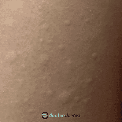 Quaddelbildung ist ein typisches Symptom der Nesselsucht.
  © doctorderma