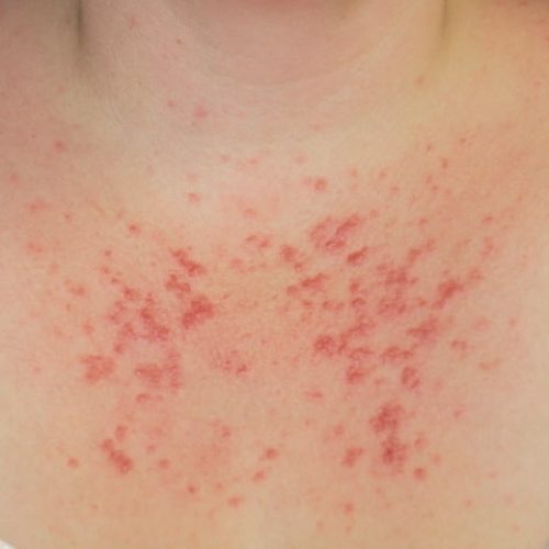 Blasenbildung als Symptom von Sonnenallergie am Dekolleté