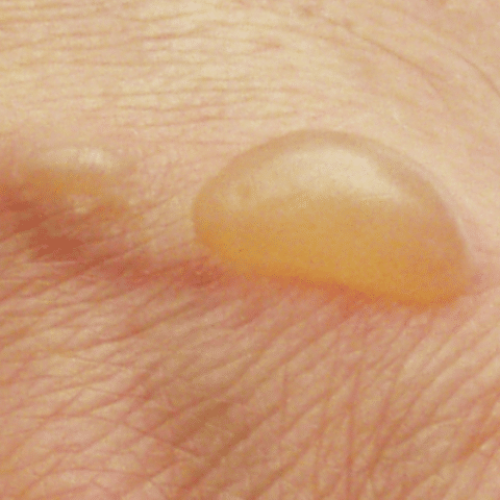 Brandblase, Flüssigkeit