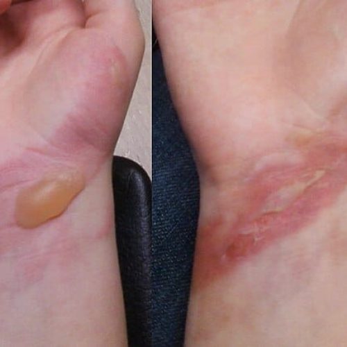 Brandblase, aufgeplatzt