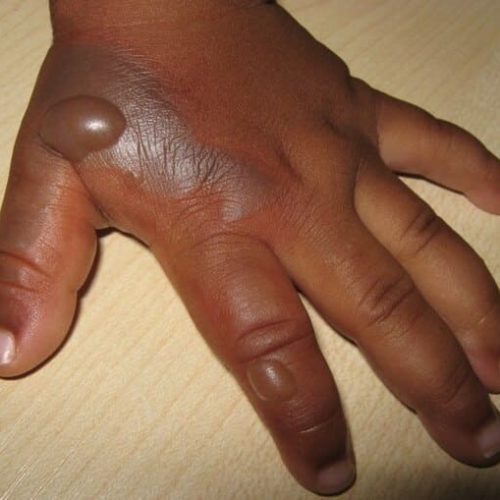 Brandblase, dunkler Hauttyp