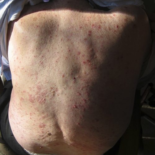 Bullöses Pemphigoid am Rücken