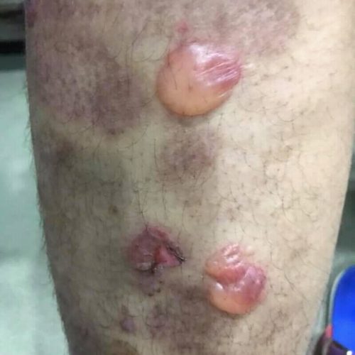 Charakteristische Blasen bei bullösem Pemphigoid