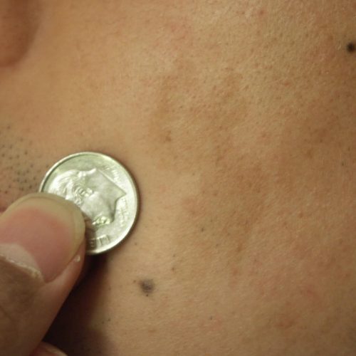 Café-au-lait-Fleck im Gesicht