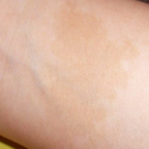 Gleichmäßig hellbraun gefärbter Café-au-lait-Fleck