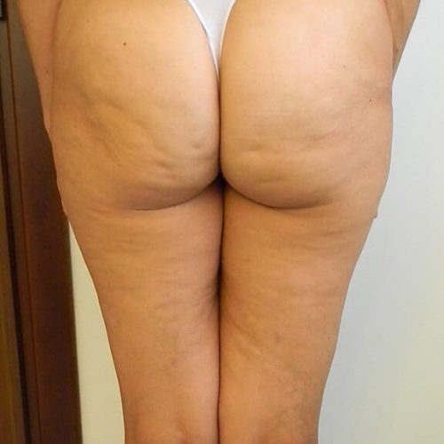 Cellulite am Gesäß
