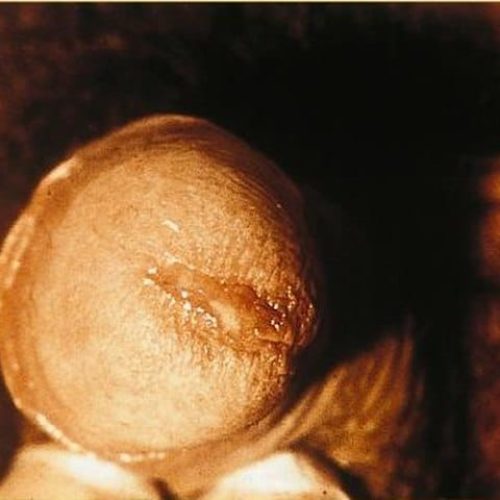 Chlamydia Ausfluss Mann