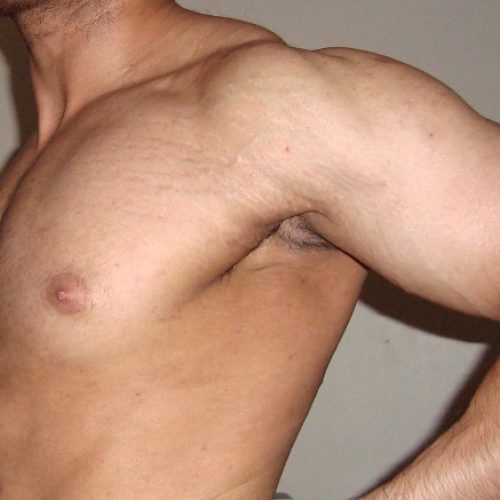 Dehnungstreifen an muskulösem Männer Oberkörper