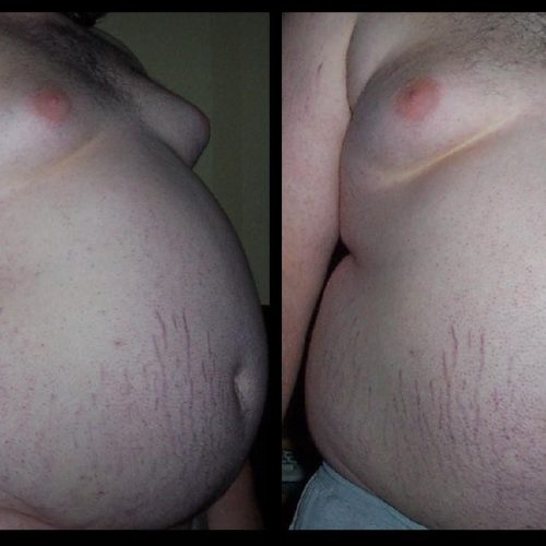 Dehnungstreifen an einem übergewichtigen Jugendlichen in Frontal- und Seit-Ansicht.