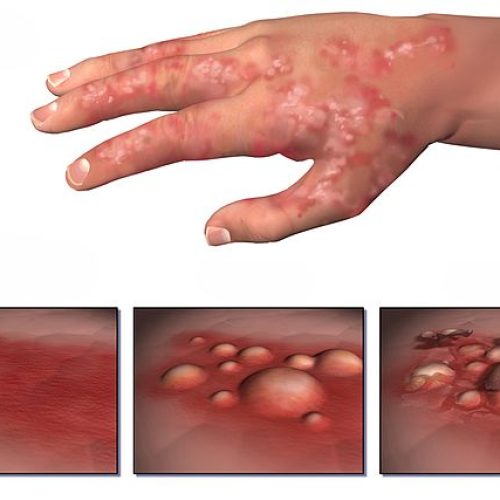 Dermatitis Progression Grafik