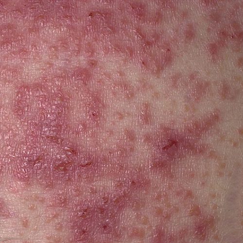 Dermatitis herpetiformis Ausschlag