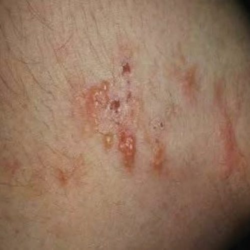 Dermatitis herpetiformis