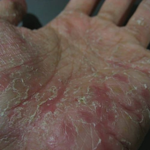 Fortgeschrittenes dyshidrotisches Ekzem an der Handfläche.