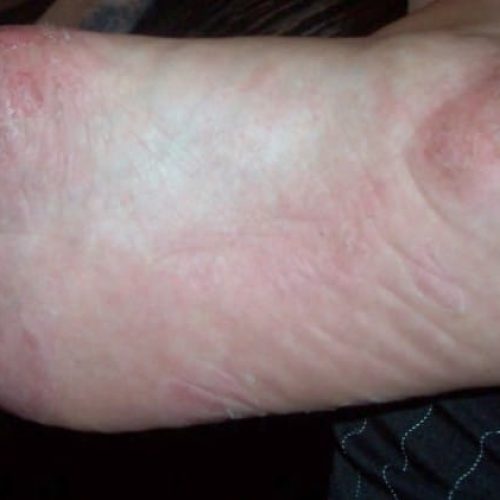 Dyshidrotisches Fußekzem