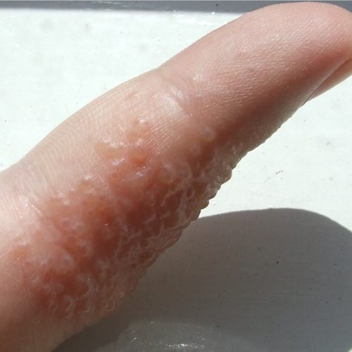 Dyshidrose Finger