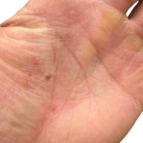 Dyshidrotisches Ekzem