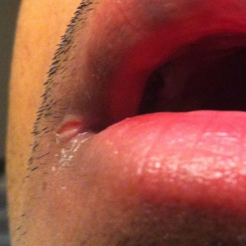 Eingerissene Mundwinkel